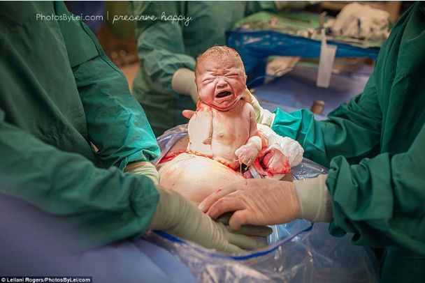 剖腹产瞬间！有惊无险，剖腹成功！
