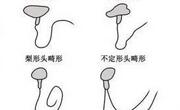 畸形精子症是什么意思？什么原因引起的？有什么危害？怎么治疗？
