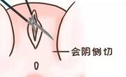 在分娩时实施会阴侧切开术是安全的