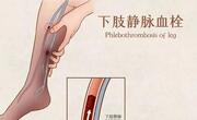 下肢深静脉血栓严重吗？原因和症状有哪些？怎么预防？