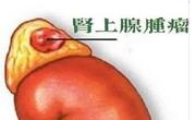 肾上腺肿瘤都有哪些症状？该怎么预防？