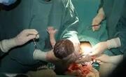 剖腹产的宝宝更容易患上这些疾病