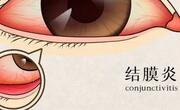 过敏性结膜炎是什么原因引起的？怎么治疗预防？