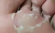 脚气用什么药最好？