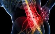 一文带你了解腰椎间盘突出症