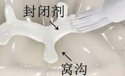 窝沟封闭是什么意思？有必要做吗？