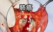 为什么这么容易得肺癌？