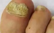 指甲（趾甲）病是由什么原因引起？