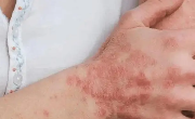 秋冬季最容易引起这6种皮肤疾病
