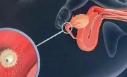作为辅助生殖方法人工授精也算是个不错的尝试