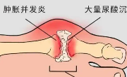 痛风性关节炎怎么引起的？急性发作期的症状表现有哪些？