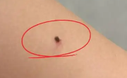 蜱虫咬人后会死吗？