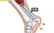 跟腱炎能自愈吗？如何防止复发？