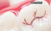 窝沟封闭是什么意思？有必要做吗？