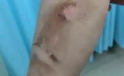 烫伤之后该如何正确处理？