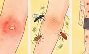 被蚊子咬了能挠吗？