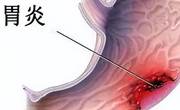 慢性胃炎怎么治疗才能彻底好？
