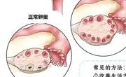 多囊卵巢综合症患者无法受孕吗？