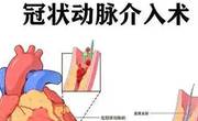 这3种介入治疗方法或许适合冠心病患者