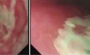 吃了点药引起了食管溃疡这是怎么回事？